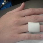 trigger finger (stenosing tenosynovitis)