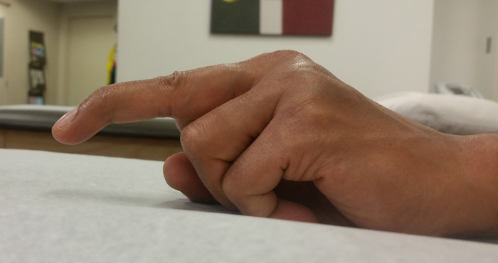 mallet finger
