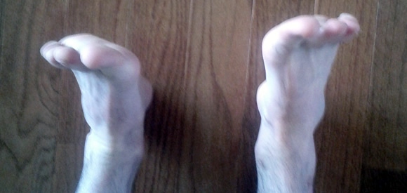 ankle sprain effects